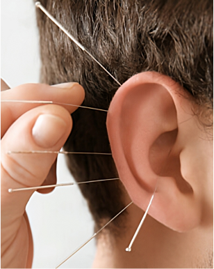 Ohrakupunktur